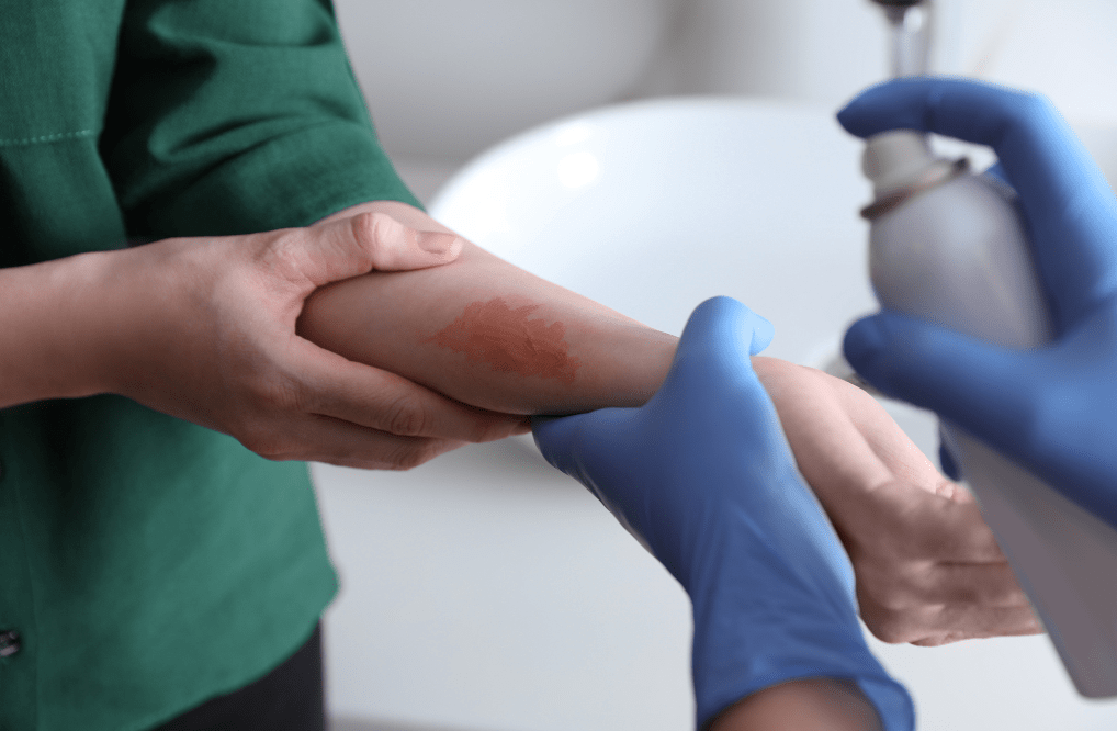 essential oil for burn relief