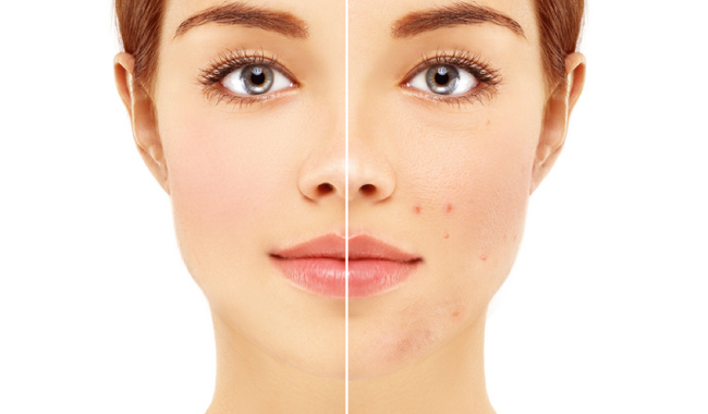 Top 5 Essential Oils for Acne Scars and Hyperpigmentation: Nature's Solution for Skin Blemishes